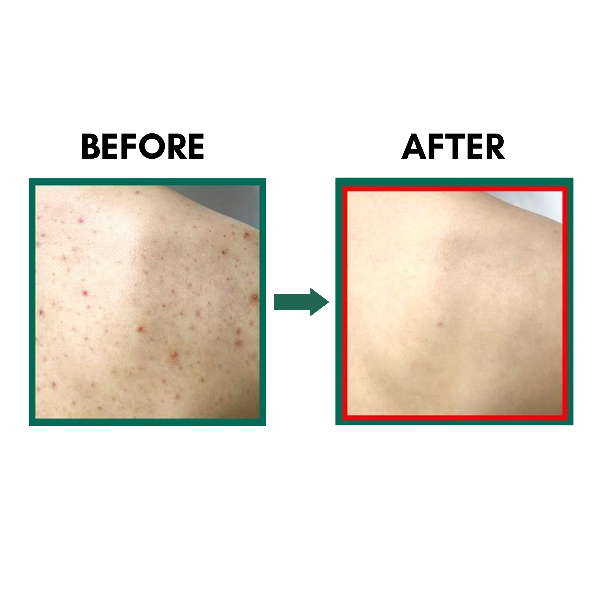 SOME BY MI AHA BHA PHA 30 Days Miracle Clear Body Cleanser (400ml) Results before and after